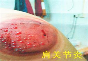 160、肩关节炎.jpg